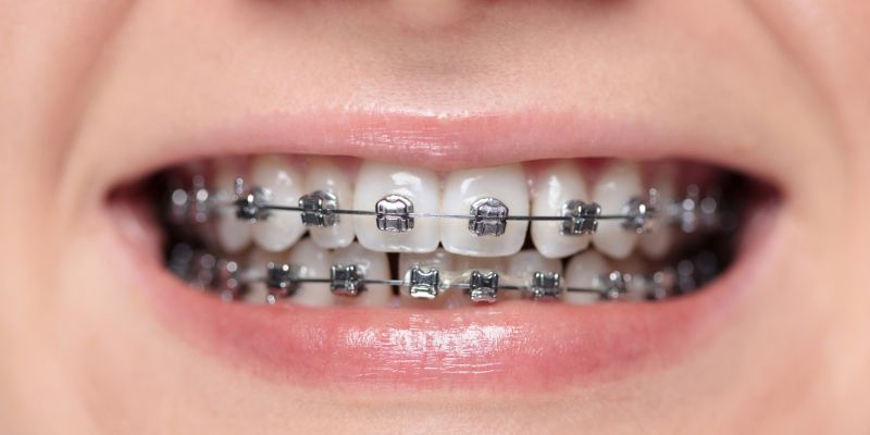 Fixed braces