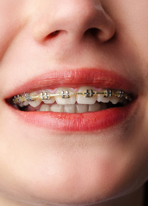 Why-choose-straight-teeth-braces
