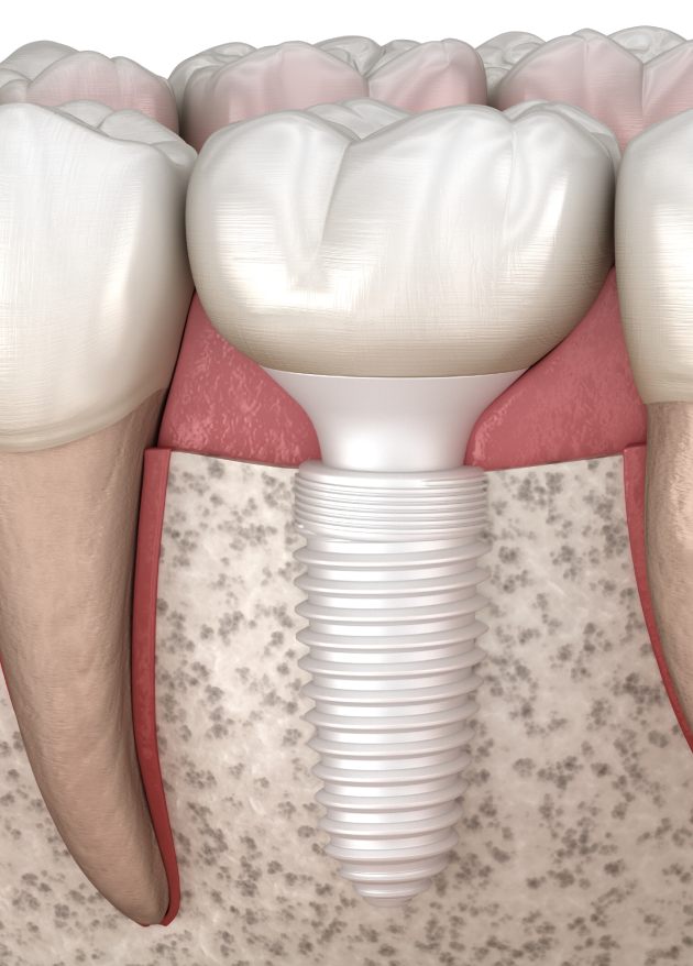 Dental-implants-treatment-at-our-practice